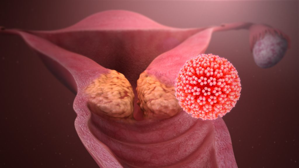 human papillomaviruses cause papilloma intraduttale cause